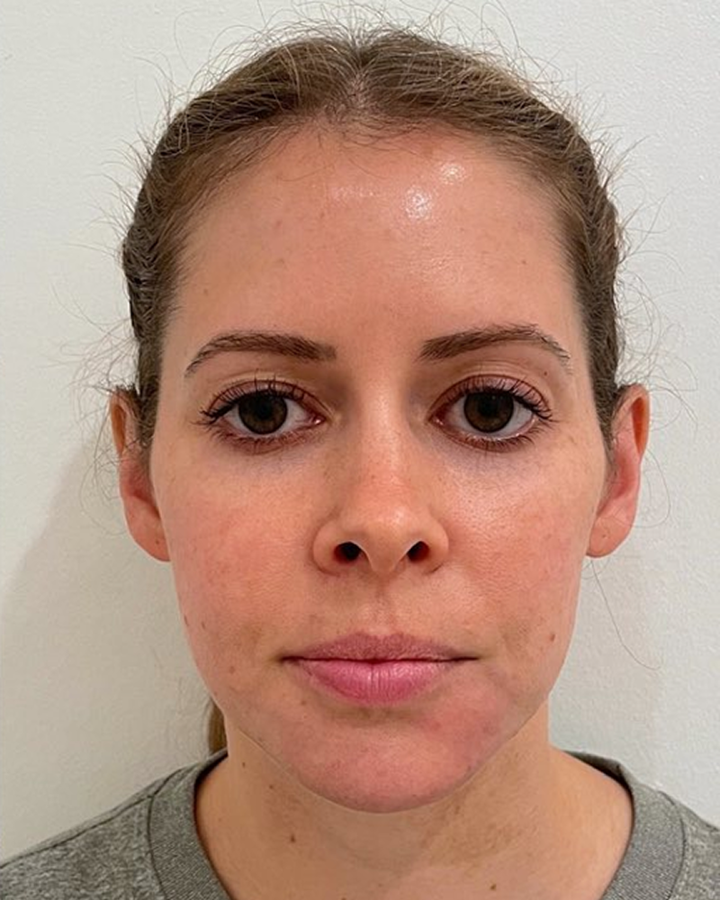 Actual treatment result at 3-month checkup